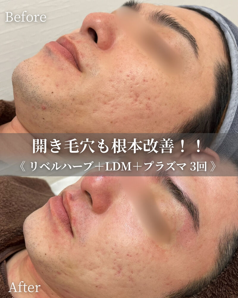 ブログ